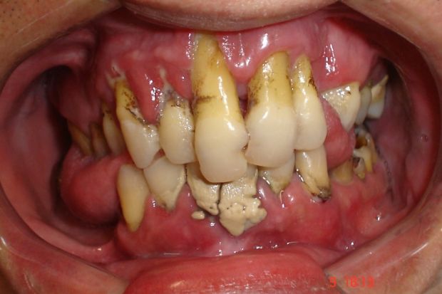 Você sabe o que é uma doença periodontal?