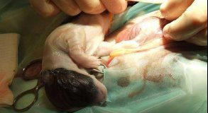 PARTO E NEONATOLOGIA